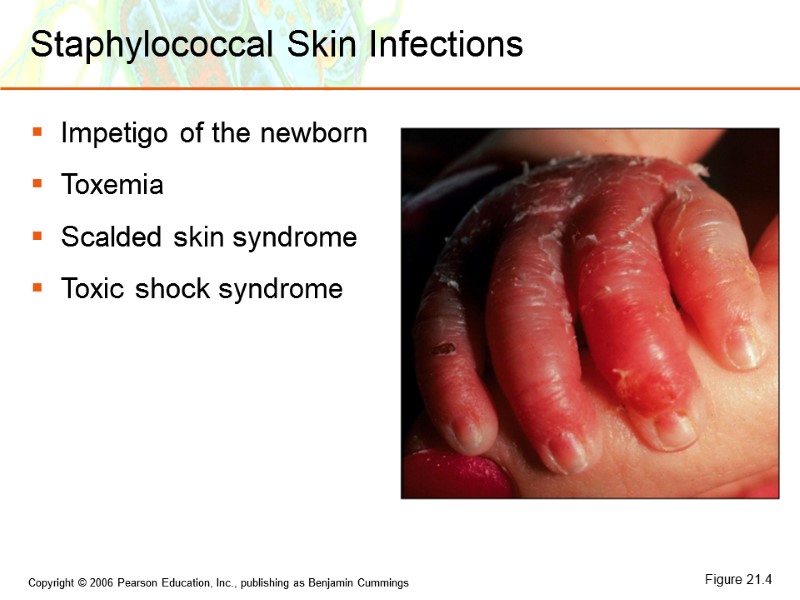 Staphylococcal Skin Infections Impetigo of the newborn Toxemia Scalded skin syndrome Toxic shock syndrome